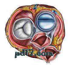 医疗领域中的十大发明Top3：人工心脏瓣膜