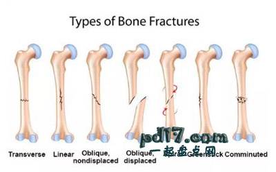 关于人类骨头的事Top1：骨折的原因