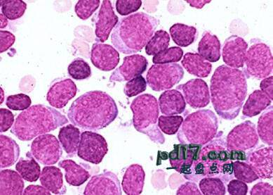 最致命的癌症Top5：急性淋巴细胞白血病