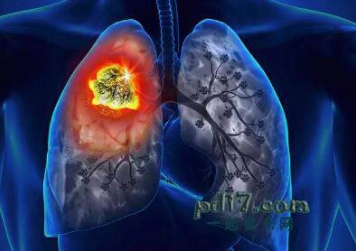 最致命的癌症Top1：肺癌