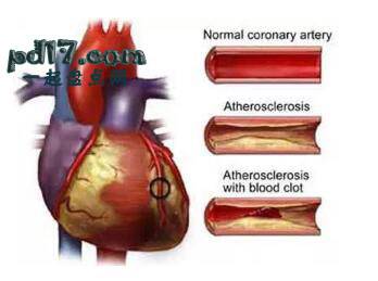 人类史上最致命的疾病Top1：冠状动脉疾病（缺血性心脏病）